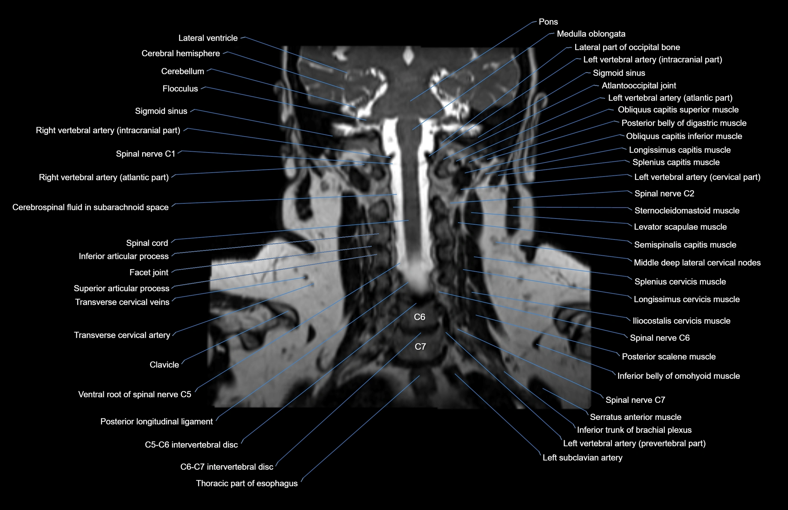 Neck coronal cross sectional MRI anatomy 3T MRI  image-img-00001-00025.webp